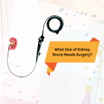 What Size of Kidney Stone Needs Surgery
